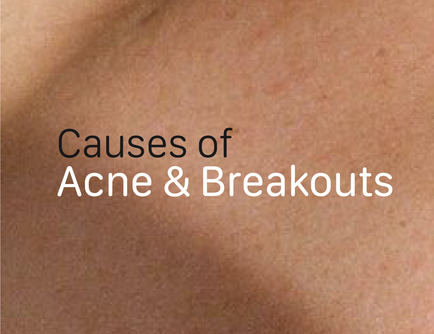 Covering breakout with acne patch